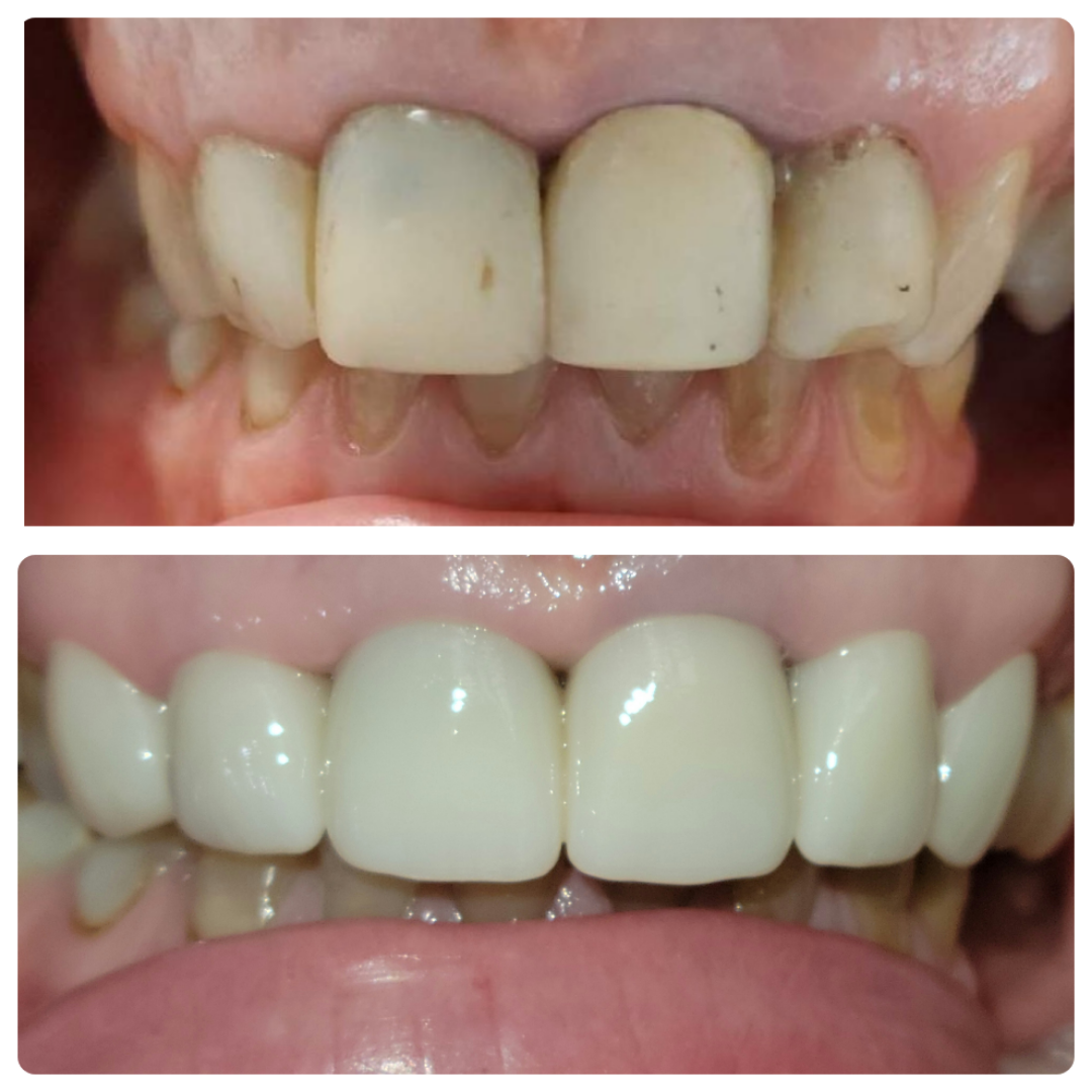 Before and after discolored front teeth restored to a uniform smile